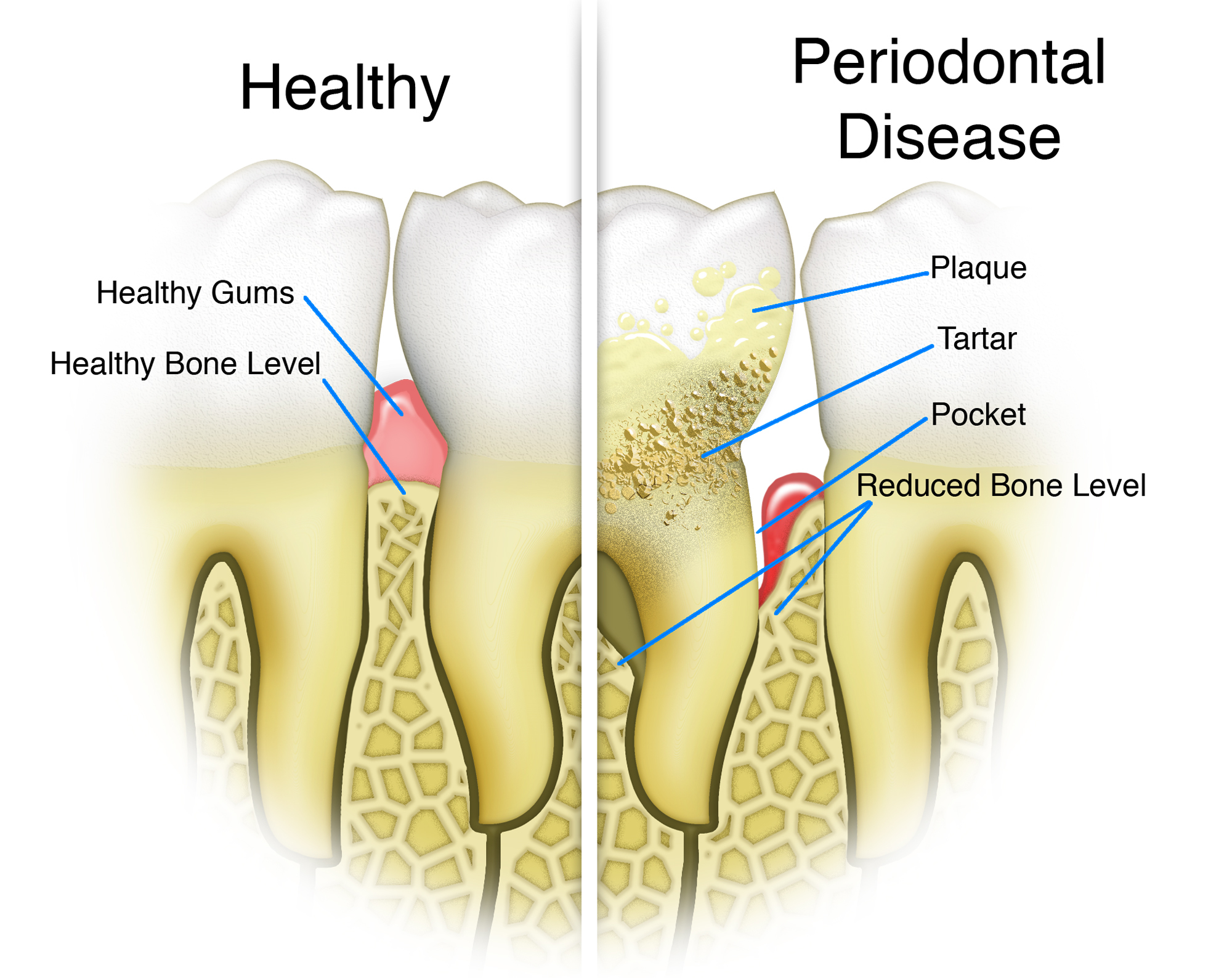 Full Mouth Disinfection – What is it ?