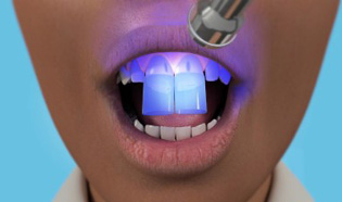 Veneers